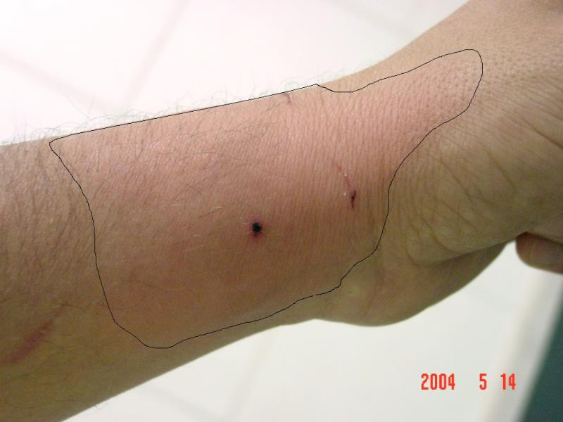 Dog And Cat Bites Hand Orthobullets